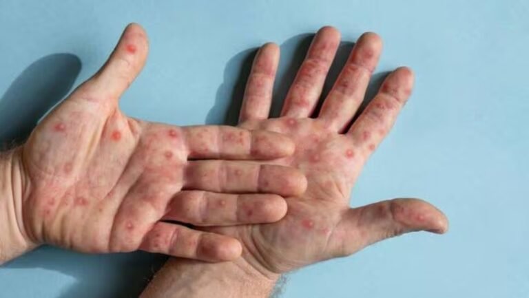 Descartan sarampión en Durango; sí hay vacunas contra esta enfermedad