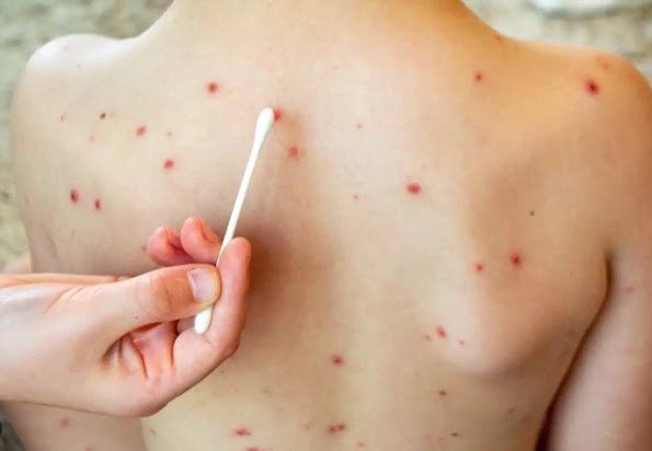 Suman 23 casos de sarampión en Durango