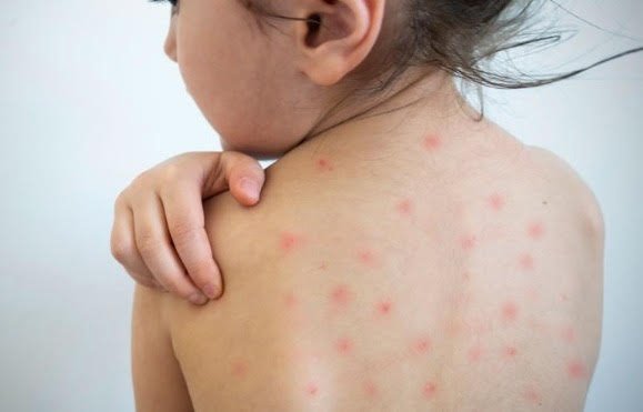 Durango suma 35 casos de sarampión: SSD